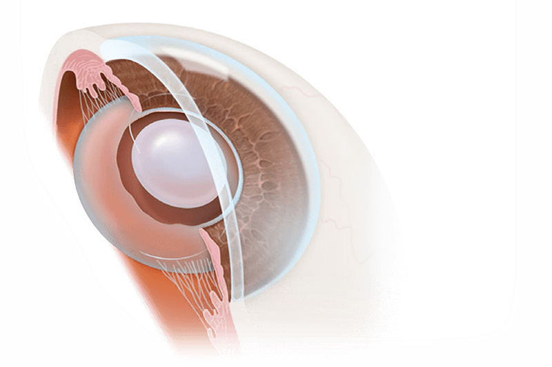operatii oftalmologice