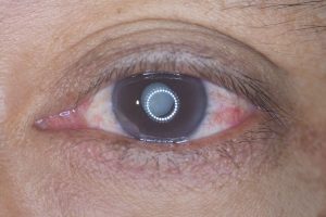 Prim plan ochi cu cataracta in timpul unui consult oftalmologic.