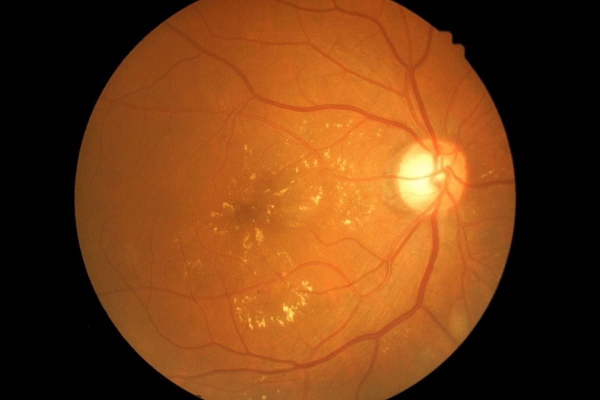 Imagine ilustrativa retinopatie diabetica