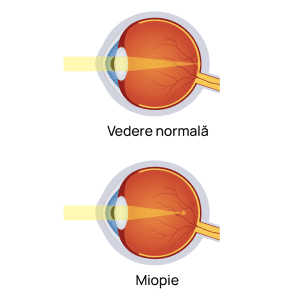 Complicatii miopie