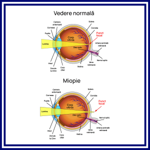 Tipuri de miopie