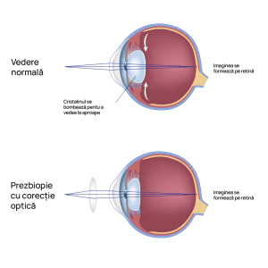 Corectie presbiopie