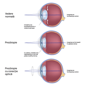 Tratament prezbiopie