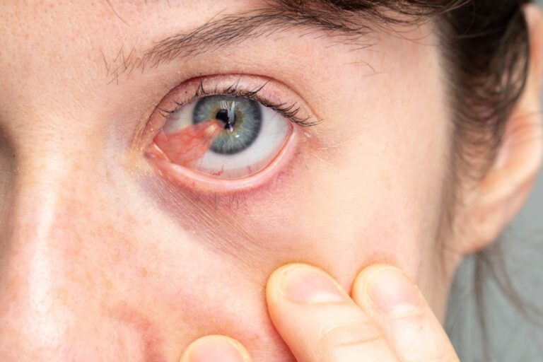 Prim plan ochi cu pterigion